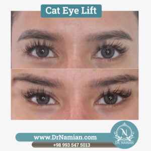 Cat Eye Lift Botox in Shiraz