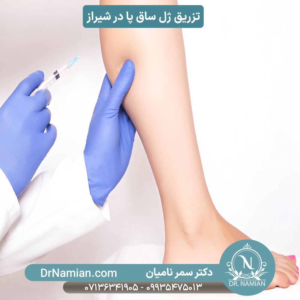 Sculpted Legs: The Art of the Calf Filler Injection
