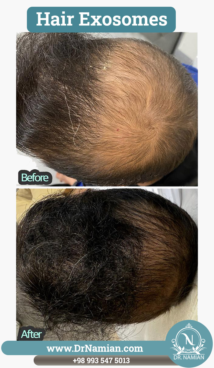 Hair exosomes Shiraz