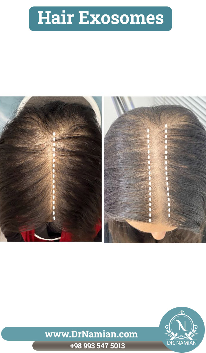 Hair exosomes in Shiraz