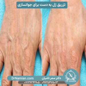 Hand Filler Treatment in Shiraz