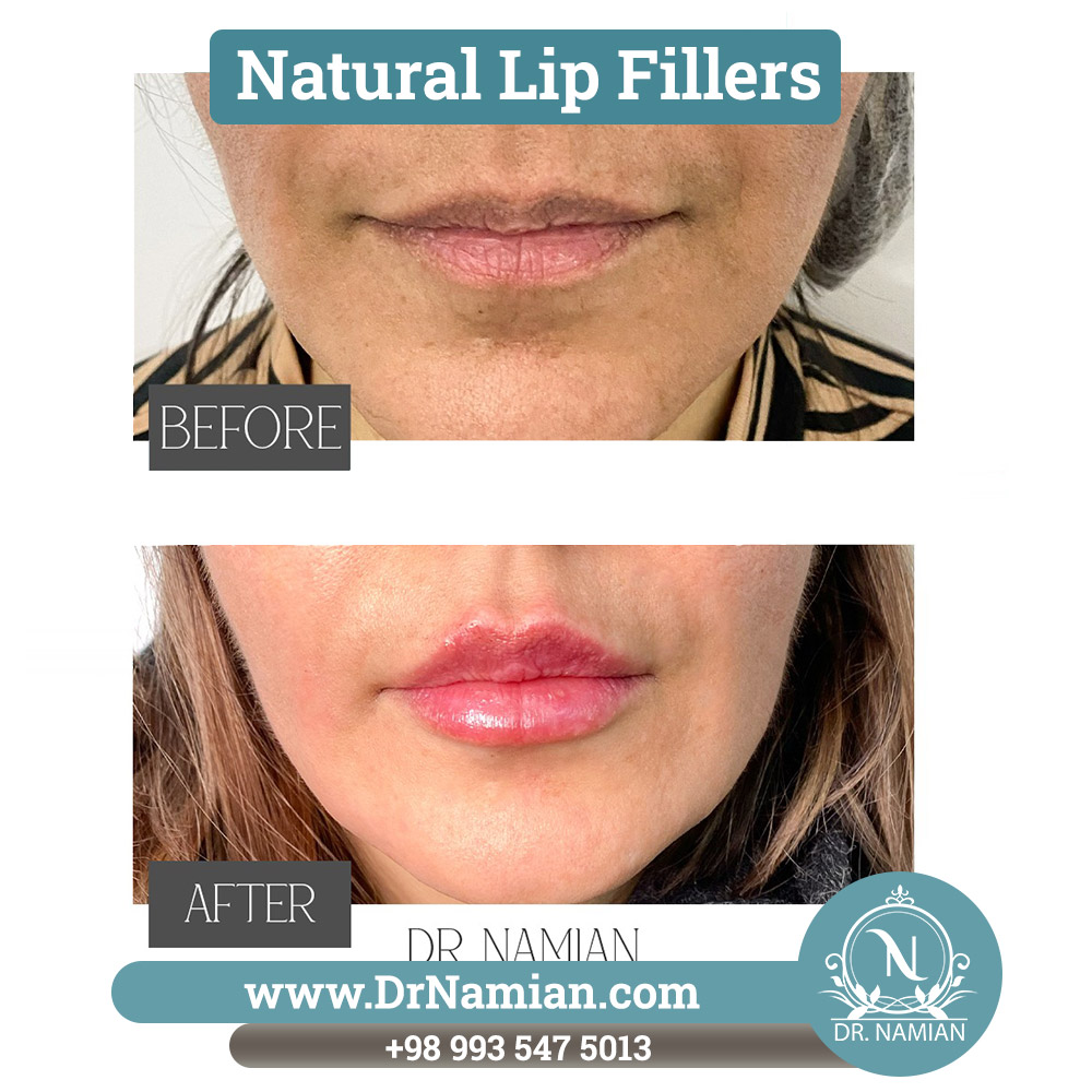 Natural Lip Fillers Shiraz