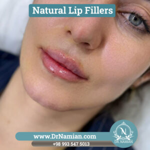 Natural Lip Fillers in Shiraz