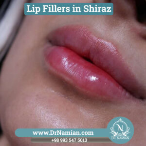 Lip Fillers in Shiraz