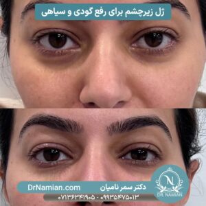 Under-Eye Fillers in Shiraz