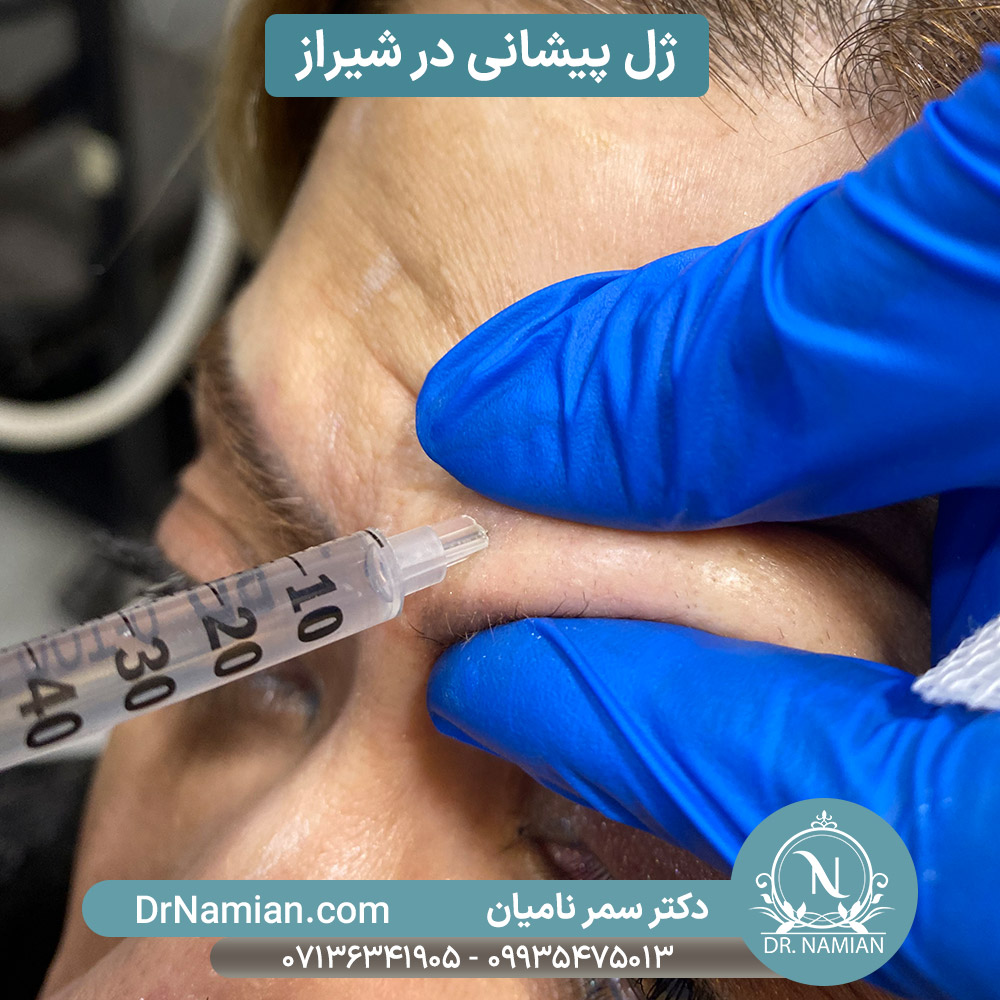 Forehead Filler Treatment in Shiraz