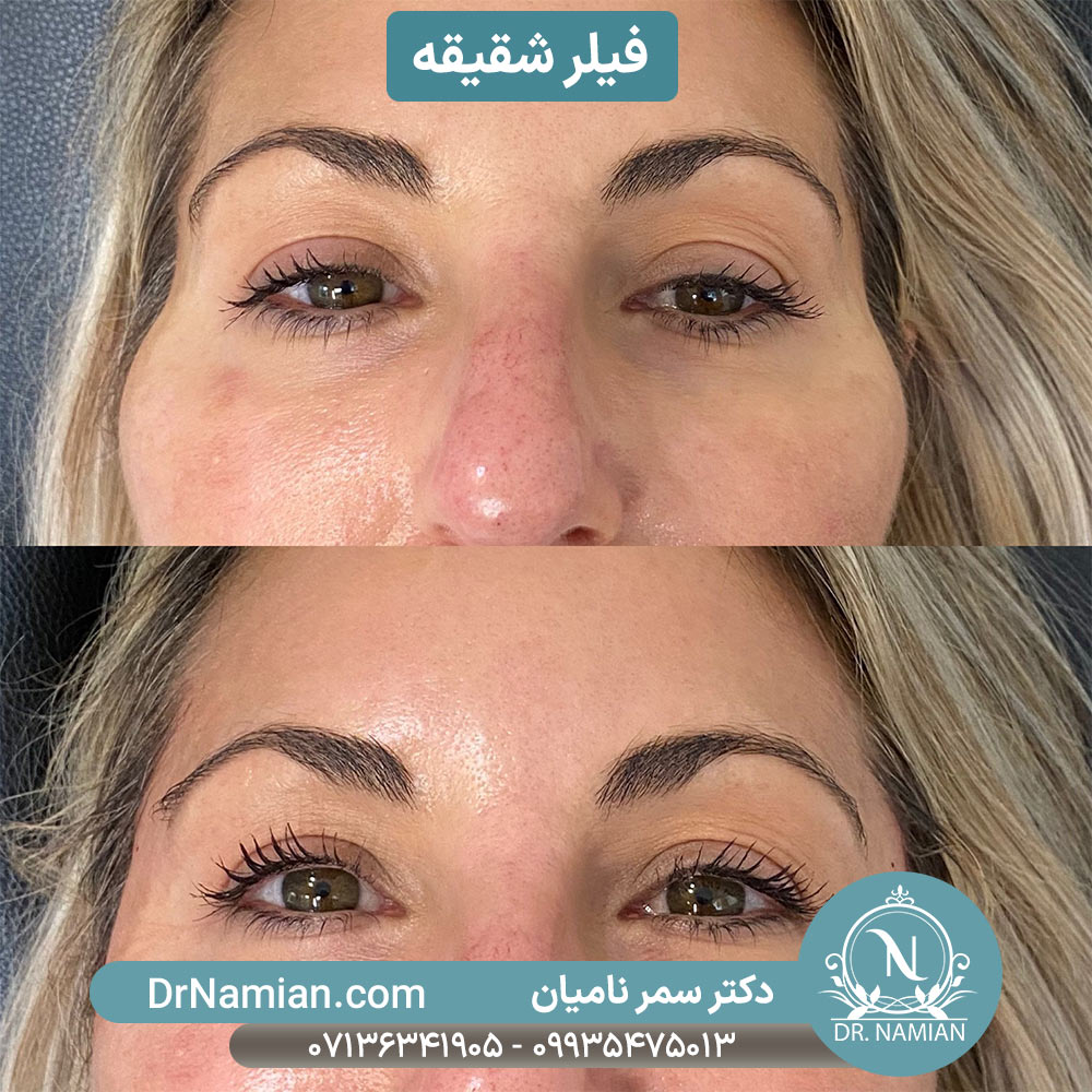 Temple Fillers in Shiraz: Restore Balance and Youth to Your Face