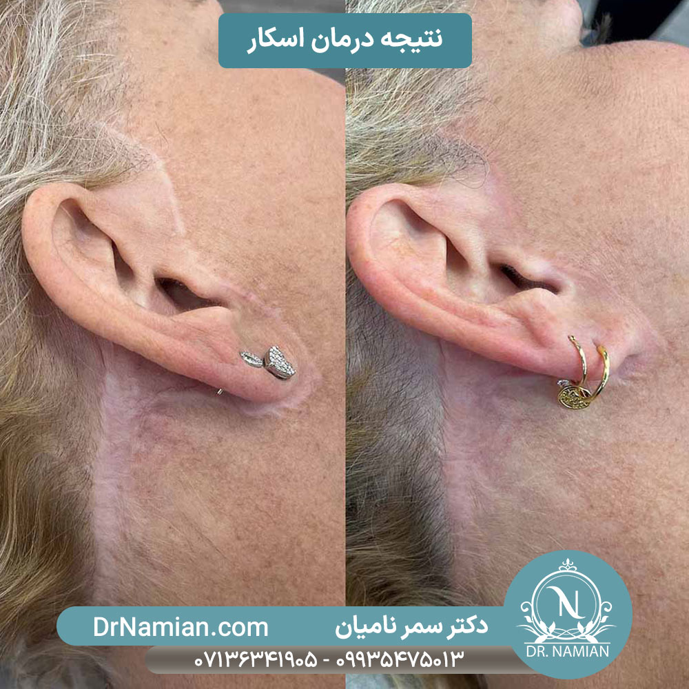 اسکار برای درمان جای زخم و جوش