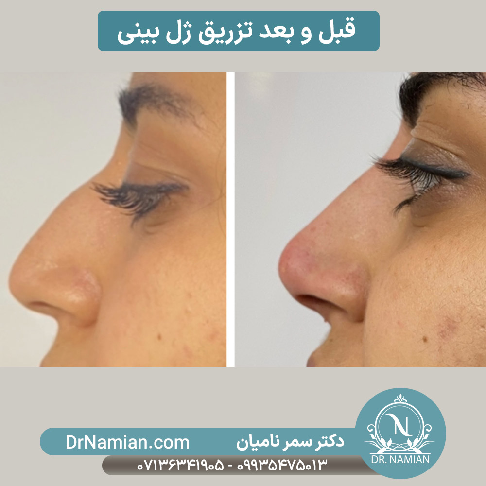 نتیجه تزریق ژل بینی شیراز