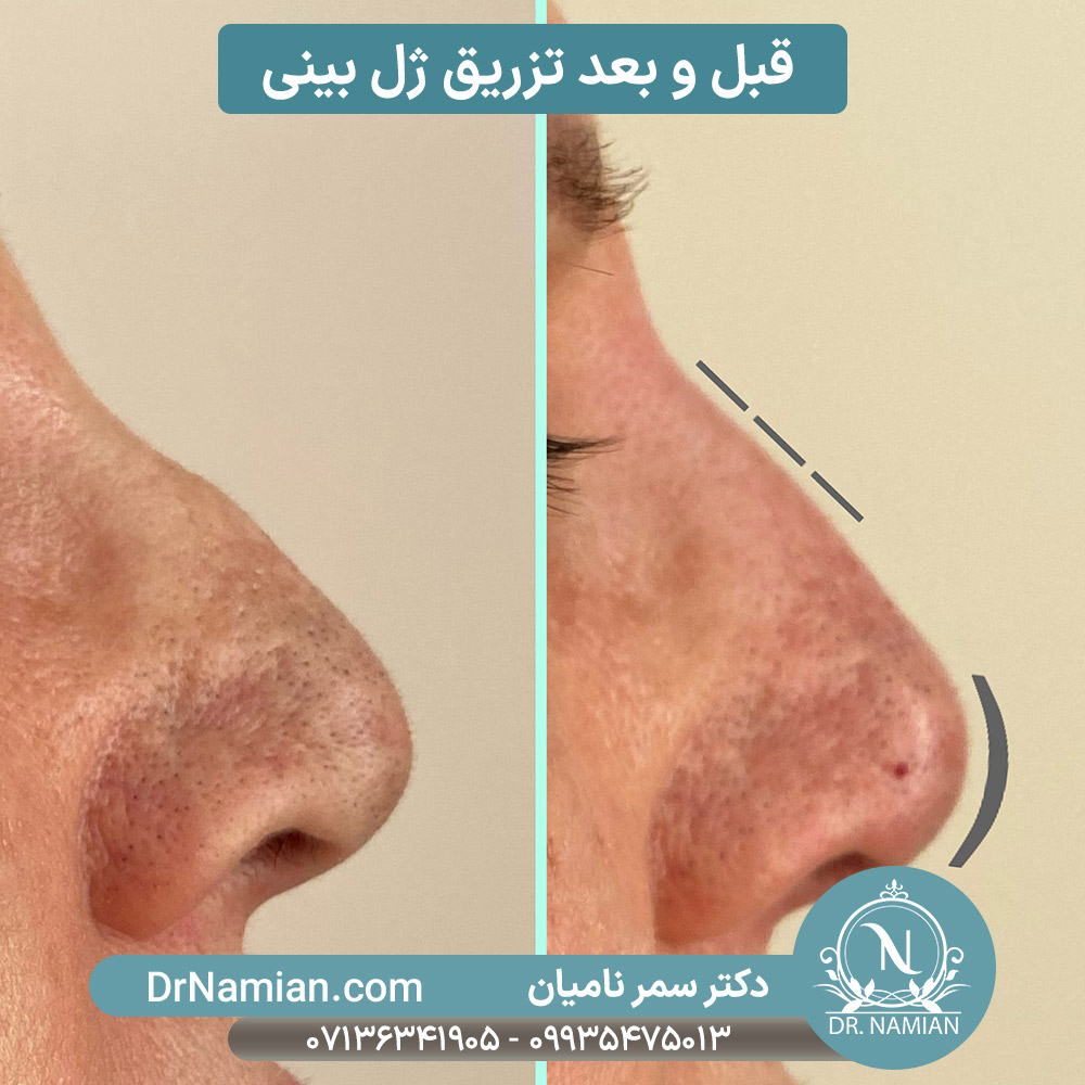 نتیجه تزریق ژل بینی در شیراز