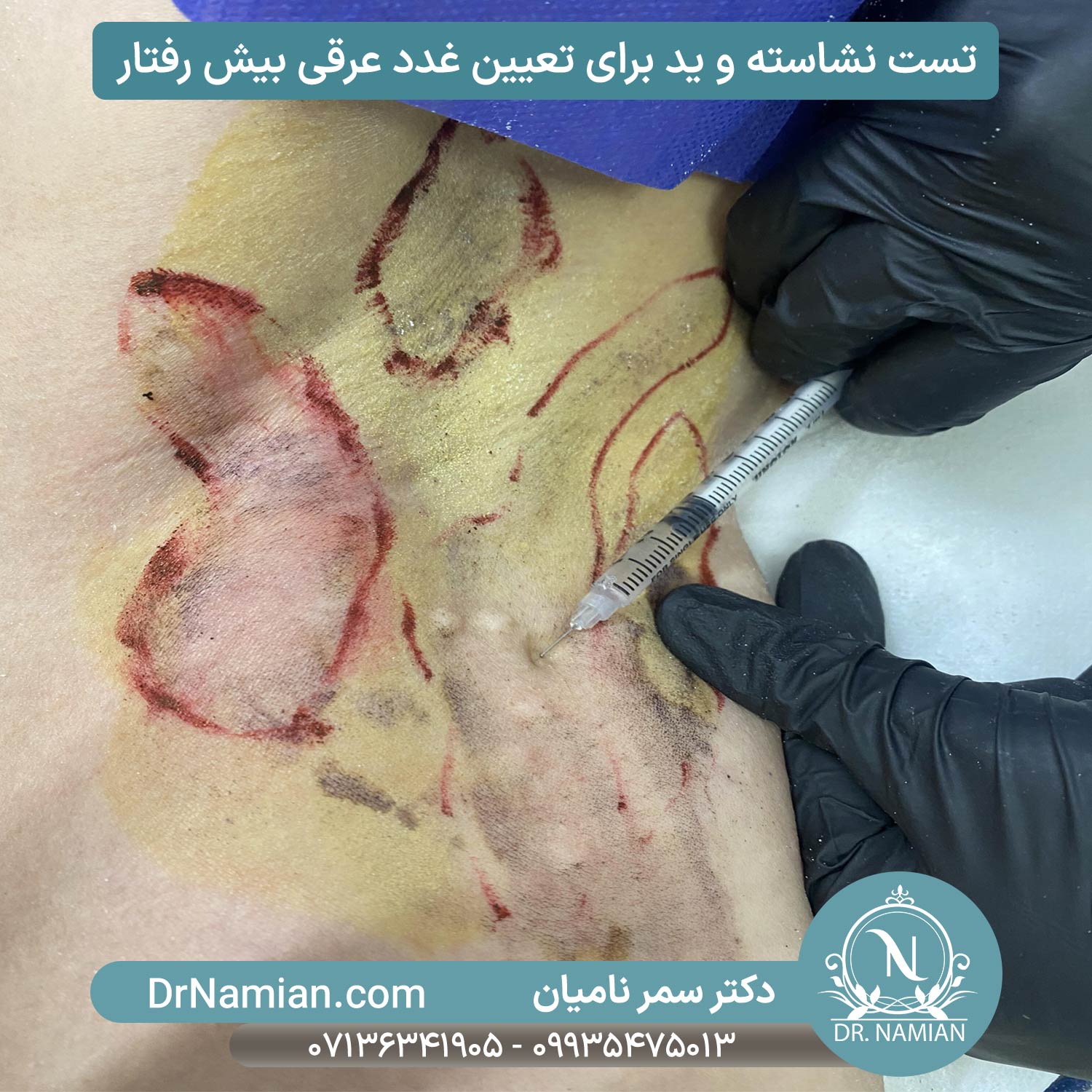 تعیین غدد عرقی قبل از تزریق کردن بوتاکس برای زیر بغل