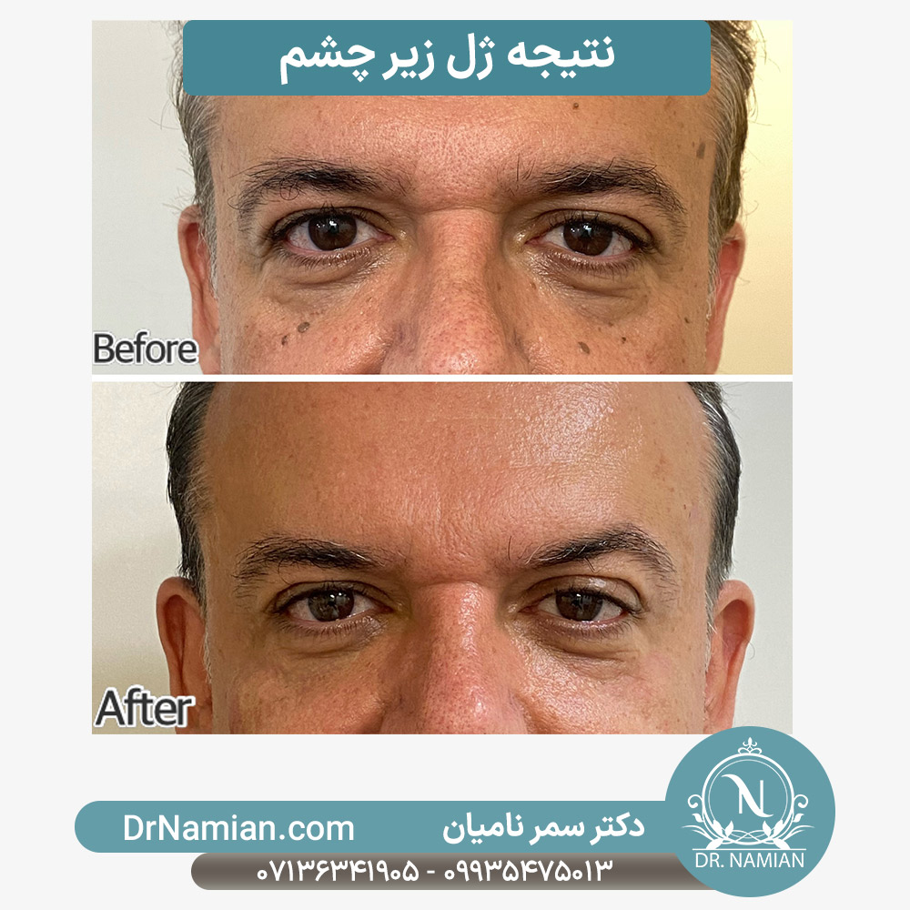 نتیجه ژل زیر چشم آقایان نتیجه ژل زیر چشم آقایان
