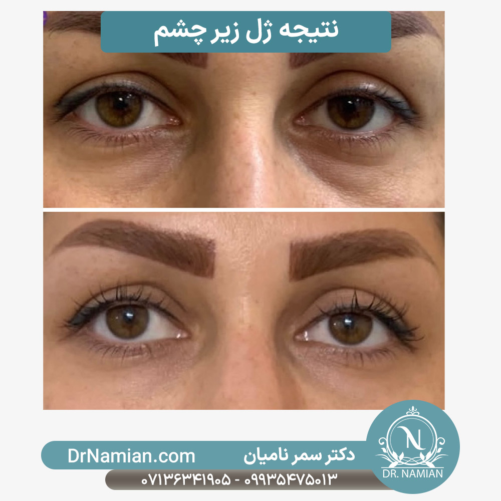 نتیجه فیلر زیر چشم خانم ها نتیجه فیلر زیر چشم خانم ها