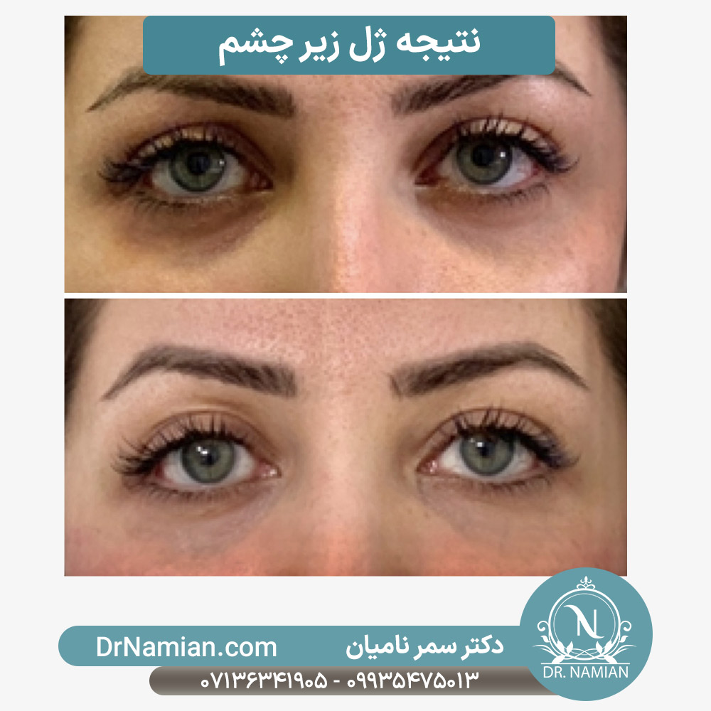 نتیجه ژل زیر چشم خانم ها نتیجه ژل زیر چشم خانم ها