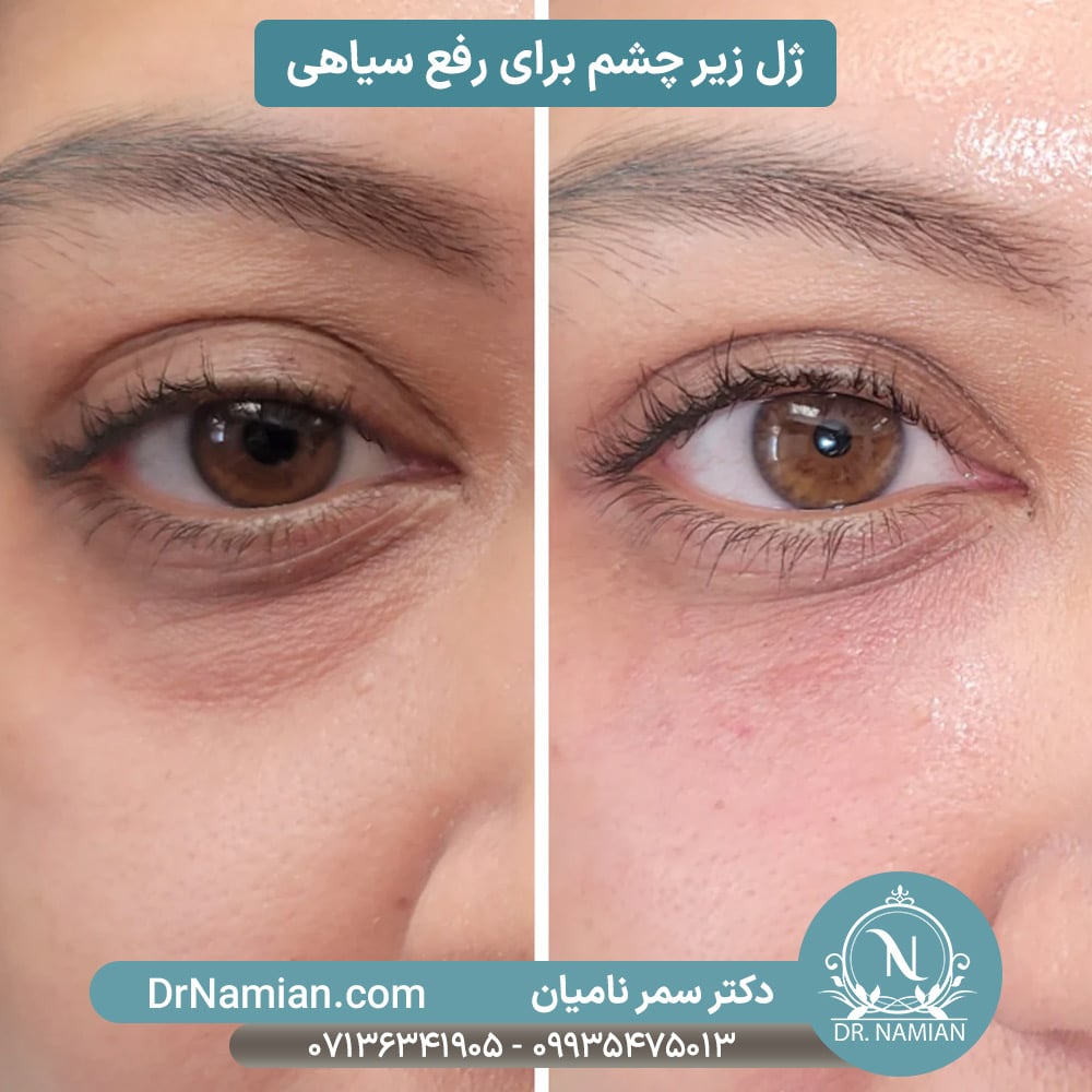 تزریق ژل زیر چشم برای رفع سیاهی و جوانسازی تزریق ژل زیر چشم برای رفع سیاهی و جوانسازی
