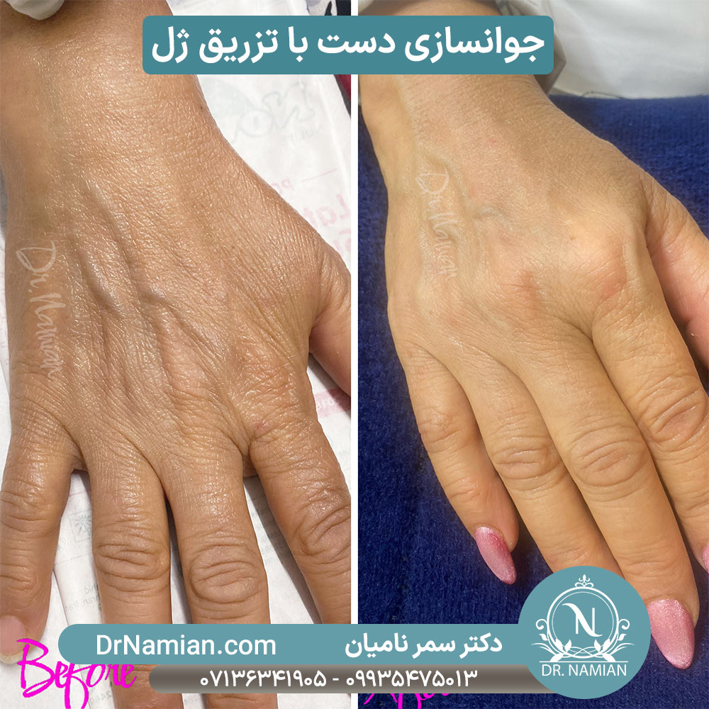 نمونه کار تزریق فیلر برای جوانسازی دست نمونه کار تزریق فیلر برای جوانسازی دست