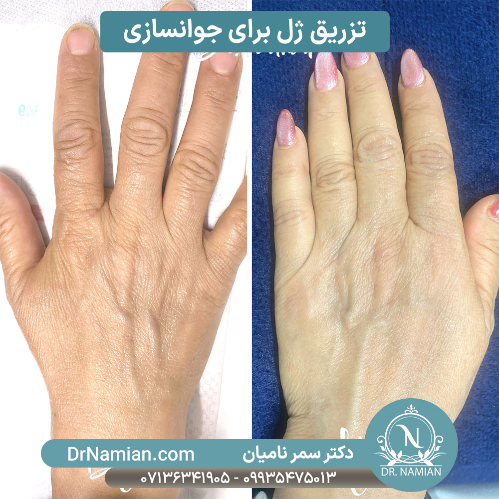 نمونه کار تزریق ژل برای جوانسازی دست نمونه کار تزریق ژل برای جوانسازی دست