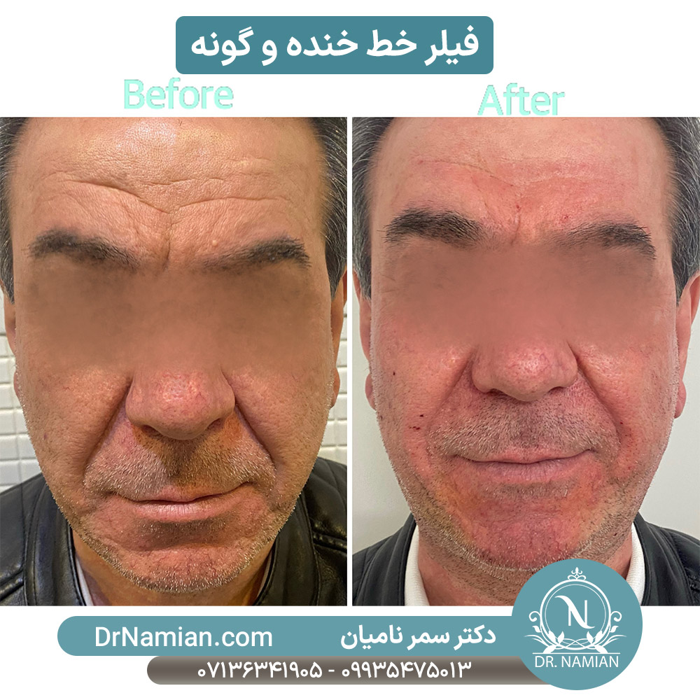 فیلر خط خنده آقایان