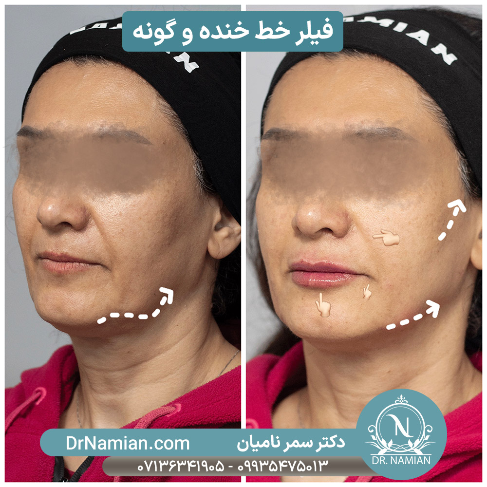 فیلر خط خنده خانم ها