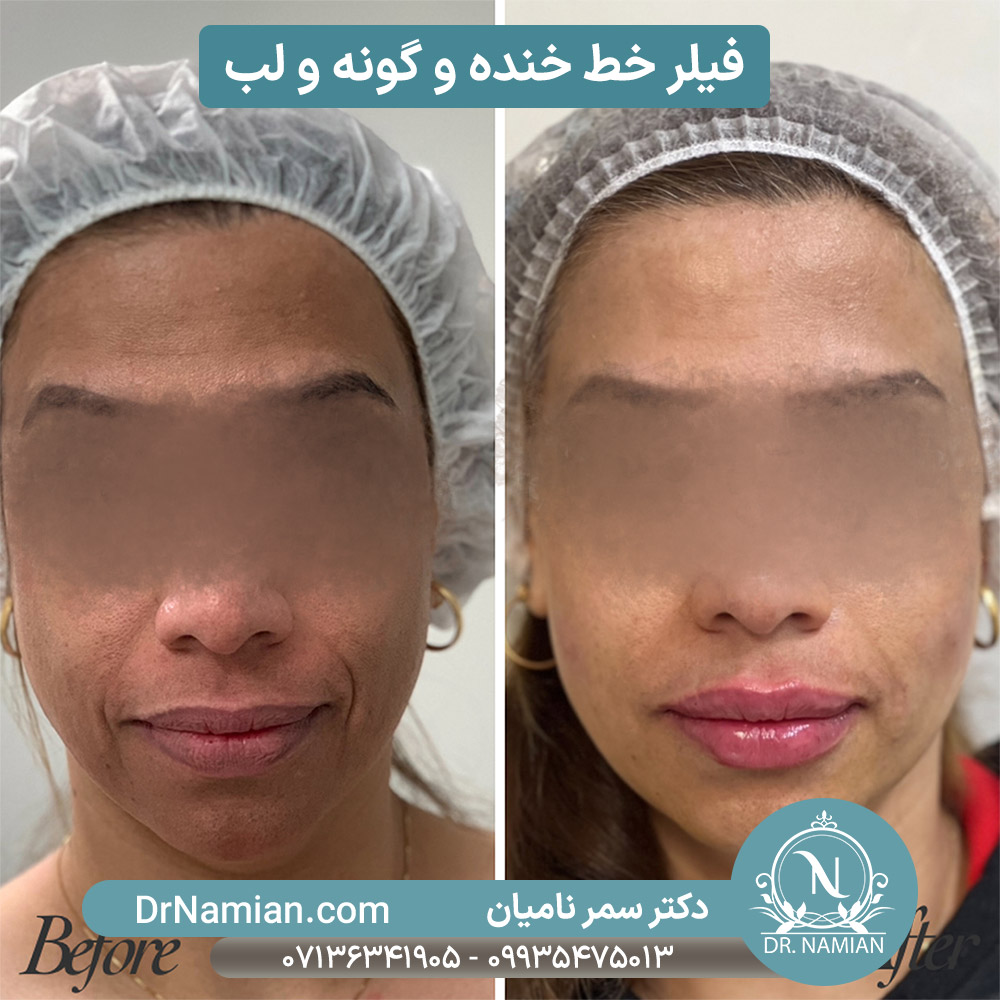 عکس قبل و بعد ژل خط خنده در شیراز