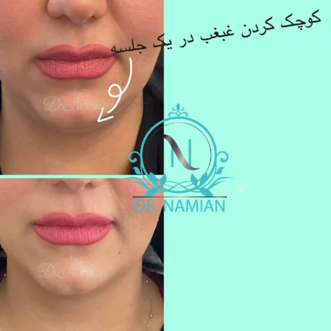 تزریق ژل چانه برای رفع غبغب - نمونه کار 4