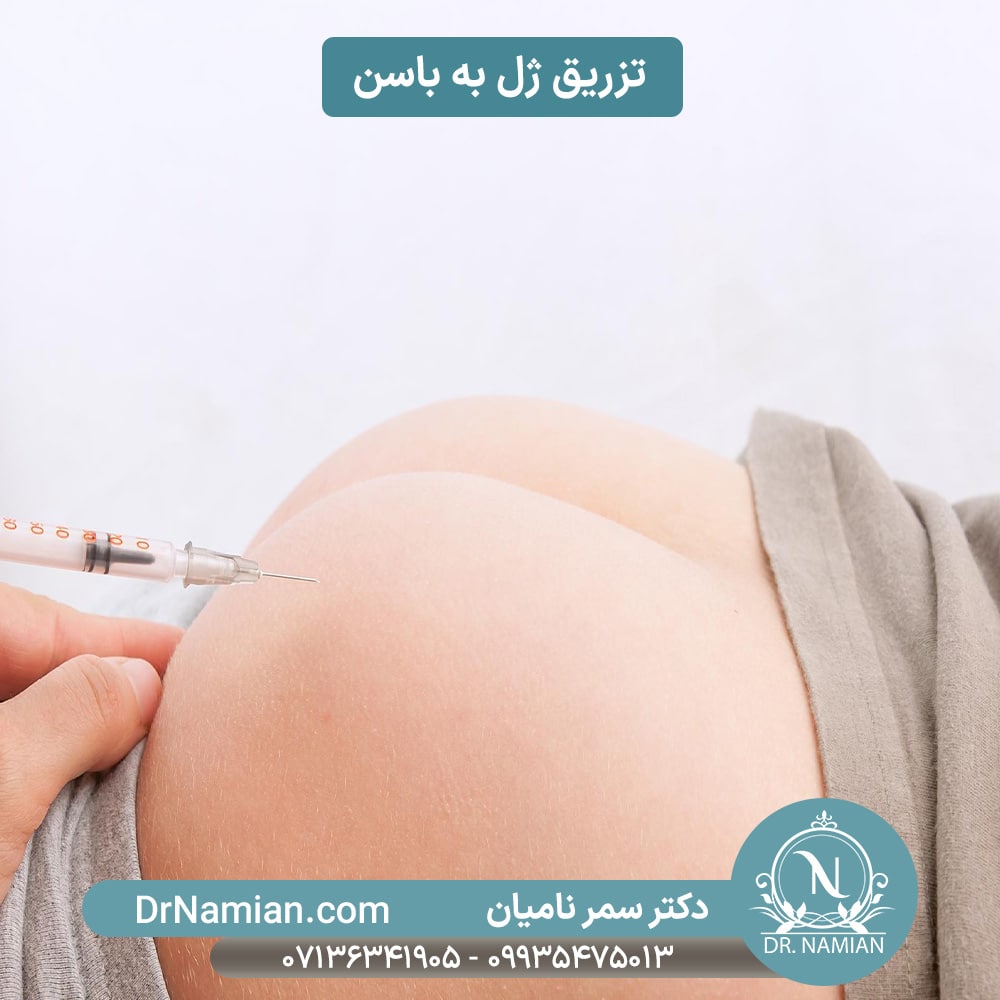 تزریق ژل باسن برای خوش فرم شدن آن
