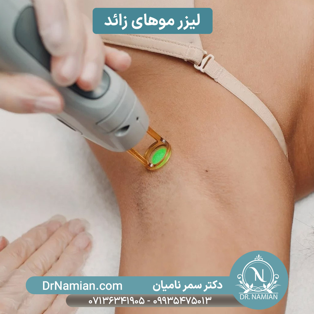 لیزر موهای زائد