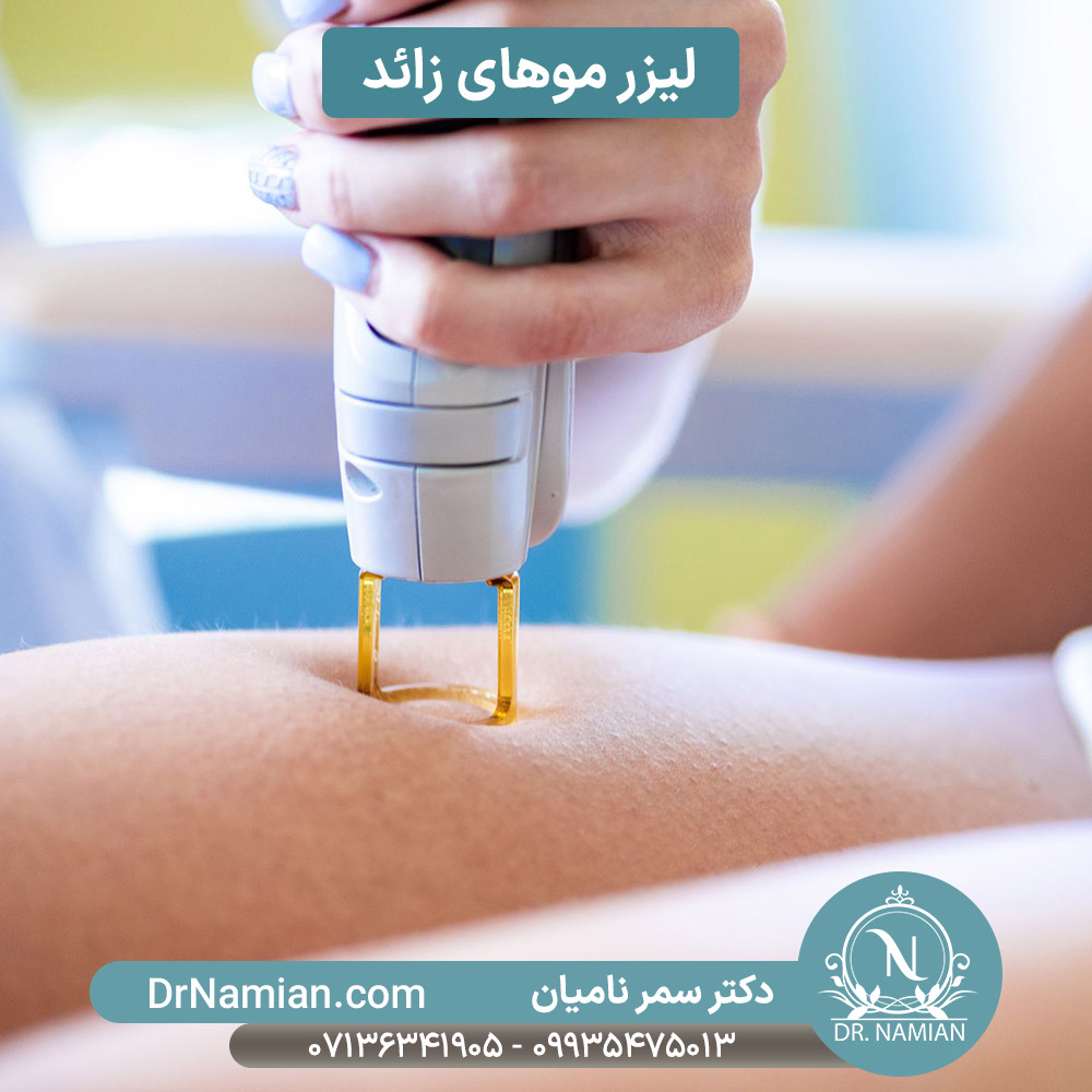 لیزر کردن موهای زائد
