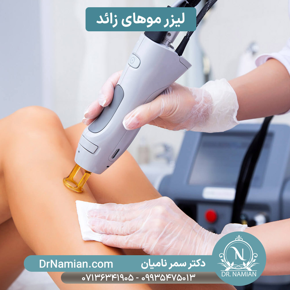 لیزر موهای زائد