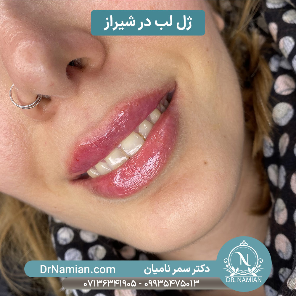 ژل لب شیراز ژل لب شیراز
