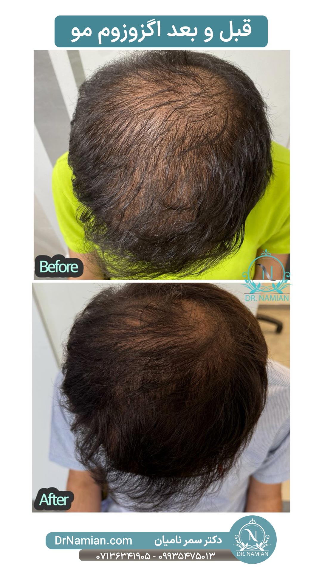 درمان ریزش مو آقایان با اگزوزوم در شیراز توسط دکتر سمر نامیان