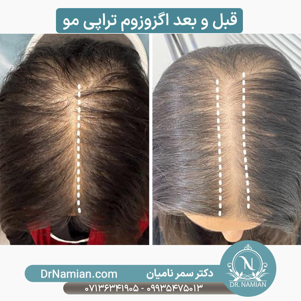 نمونه کار درمان ریزش با اگزوزوم تراپی