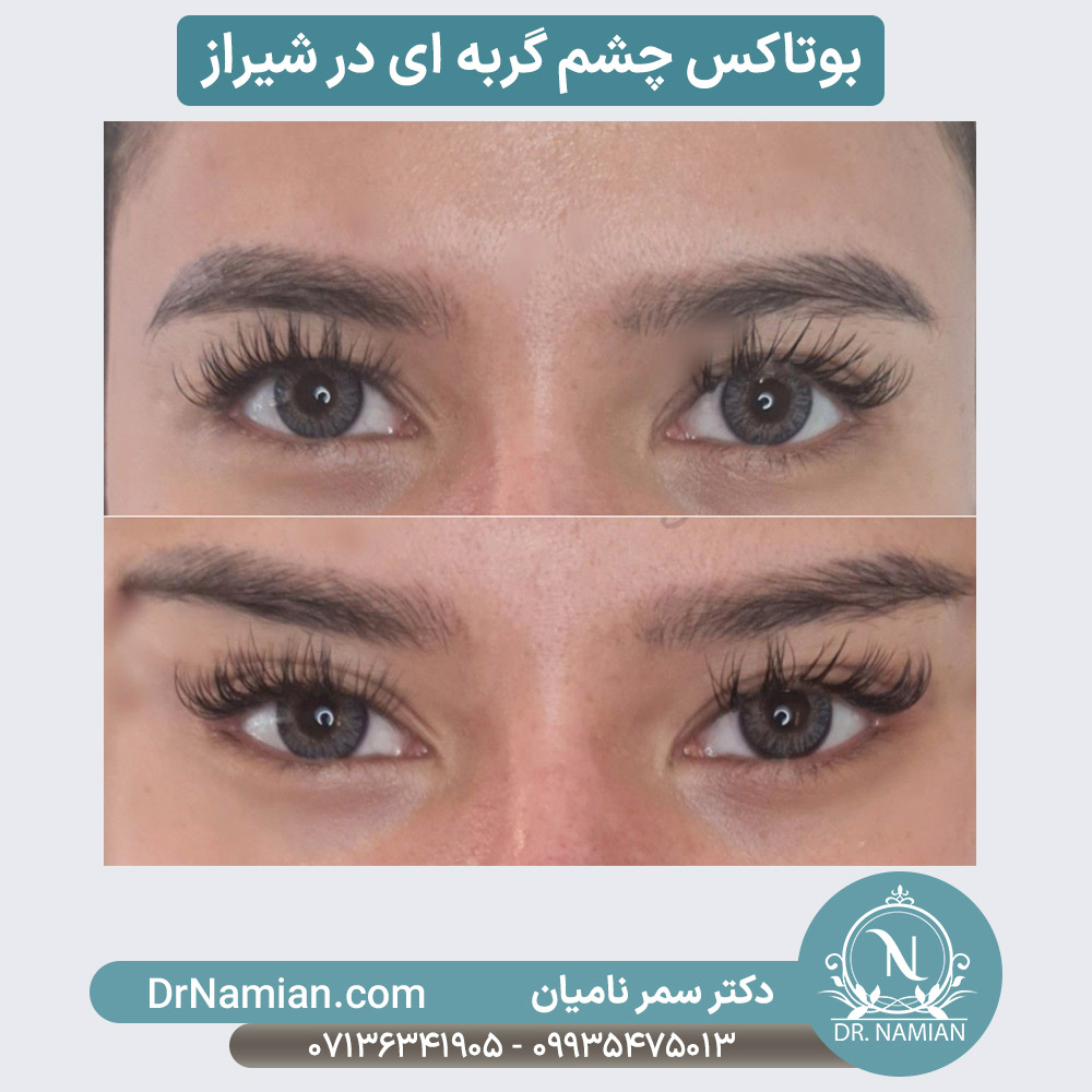 بوتاکس چشم گربه ای در شیراز