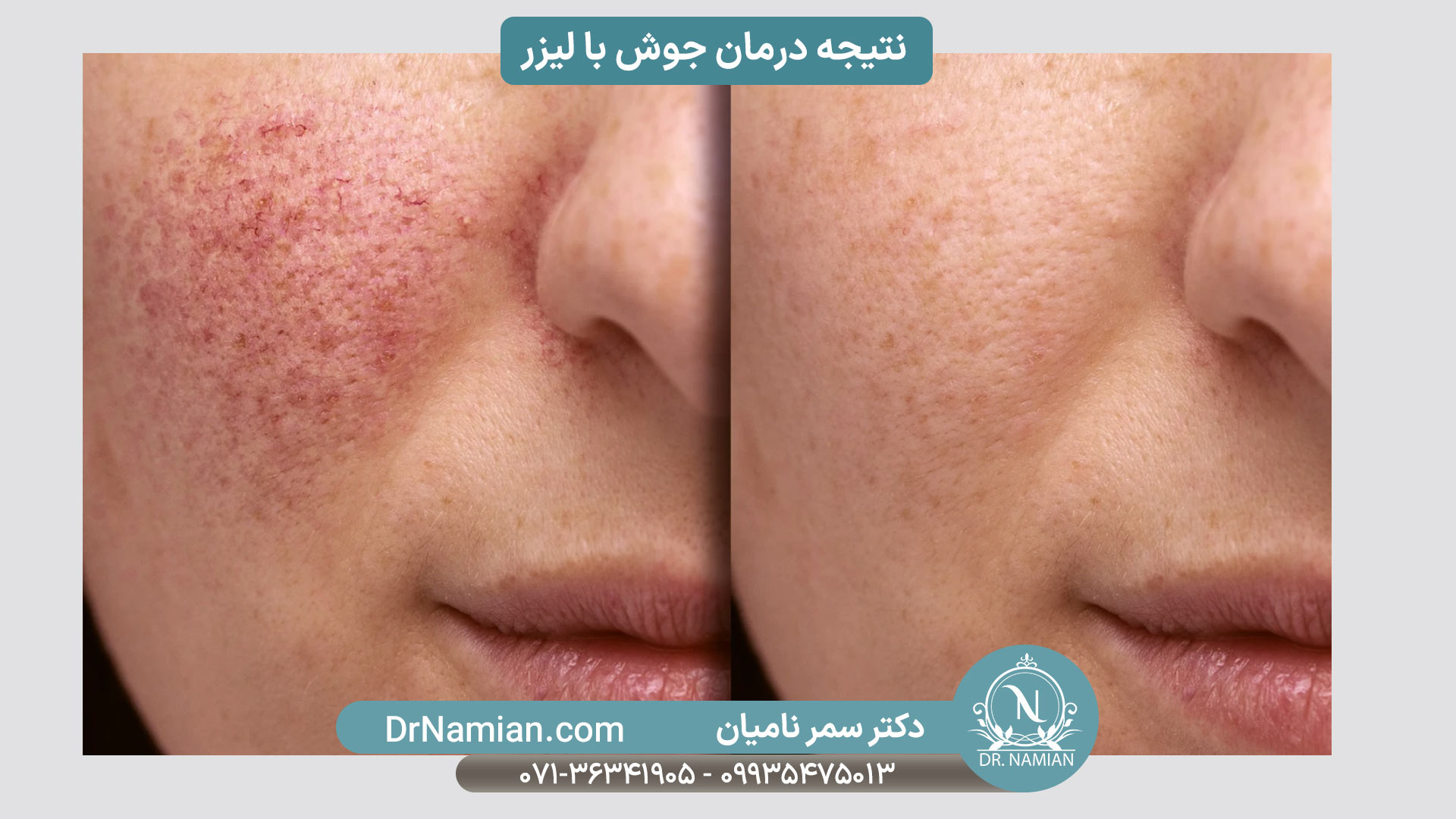 درمان جوش با لیزر توسط دکتر سمر نامیان
