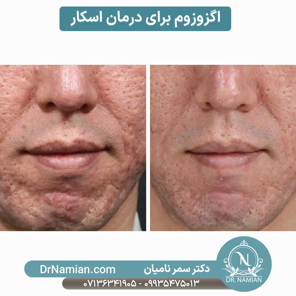 اگزوزوم برای درمان اسکار و جای زخم در شیراز اگزوزوم برای درمان اسکار و جای زخم در شیراز