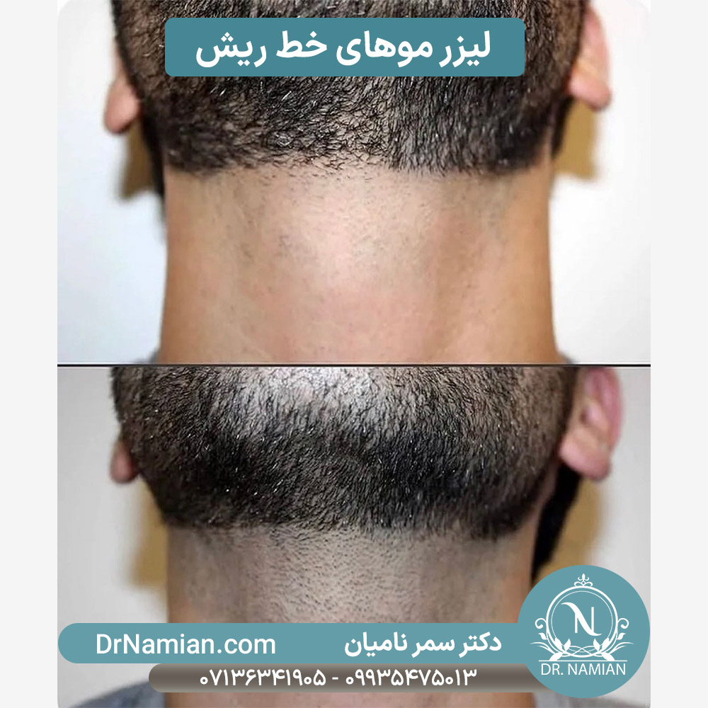 لیزر خط ریش در شیراز