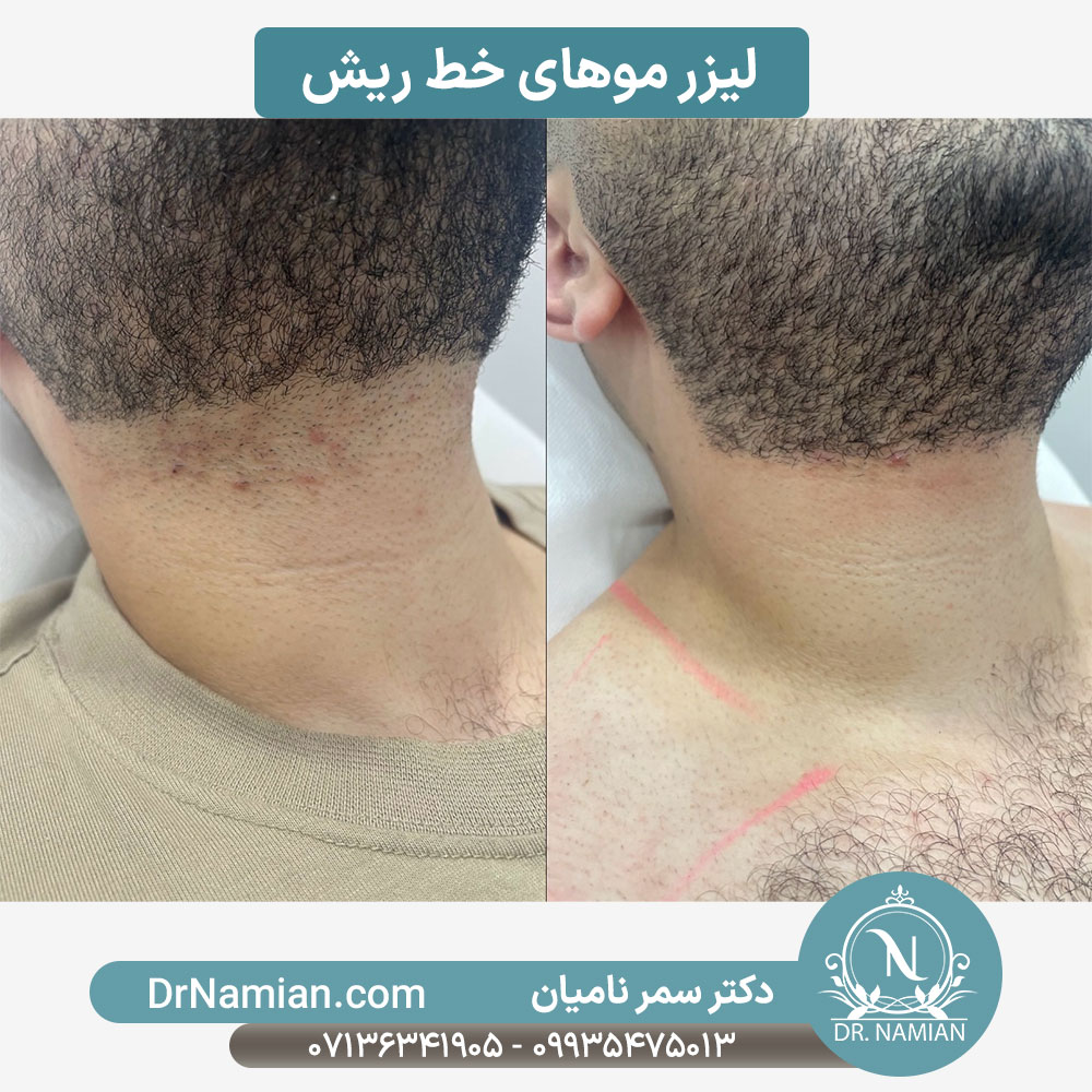 نتیجه لیزر خط ریش نتیجه لیزر خط ریش