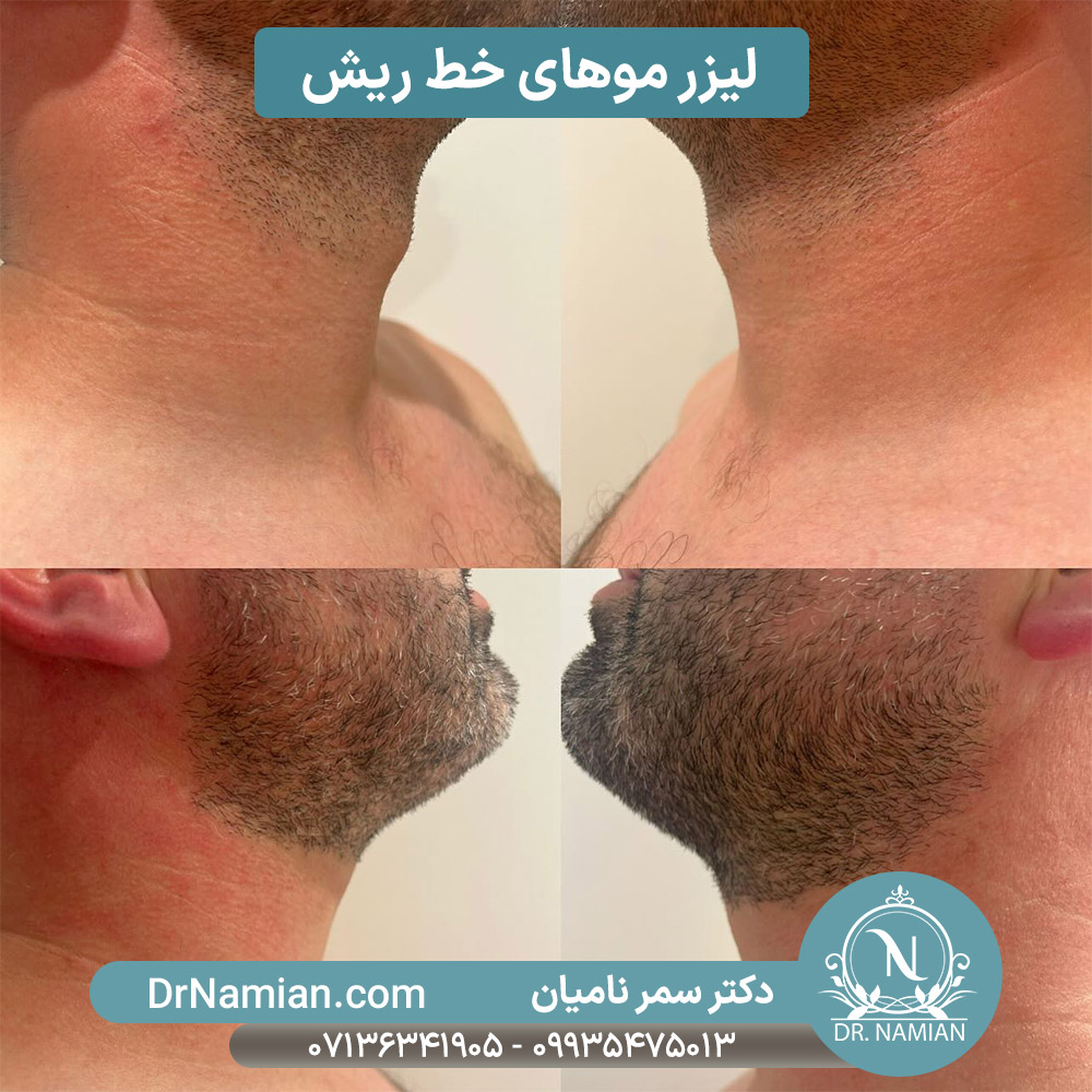 لیزر خط ریش در شیراز لیزر خط ریش در شیراز