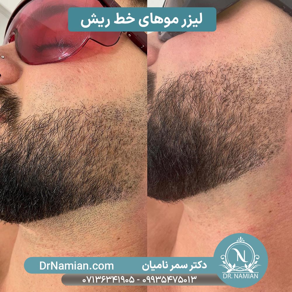 عکس قبل و بعد لیزر خط ریش شیراز عکس قبل و بعد لیزر خط ریش شیراز