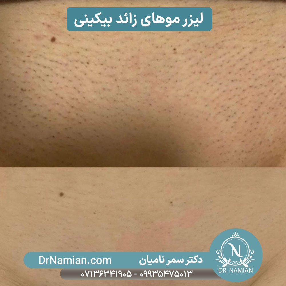 لیزر موهای بیکینی شیراز لیزر موهای بیکینی شیراز