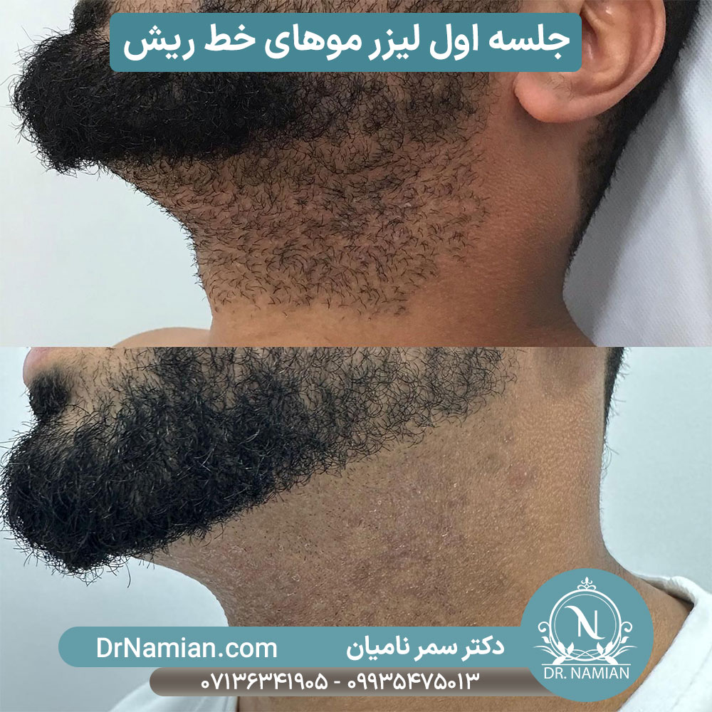 نتیجه جلسه اول لیزر خط ریش نتیجه جلسه اول لیزر خط ریش