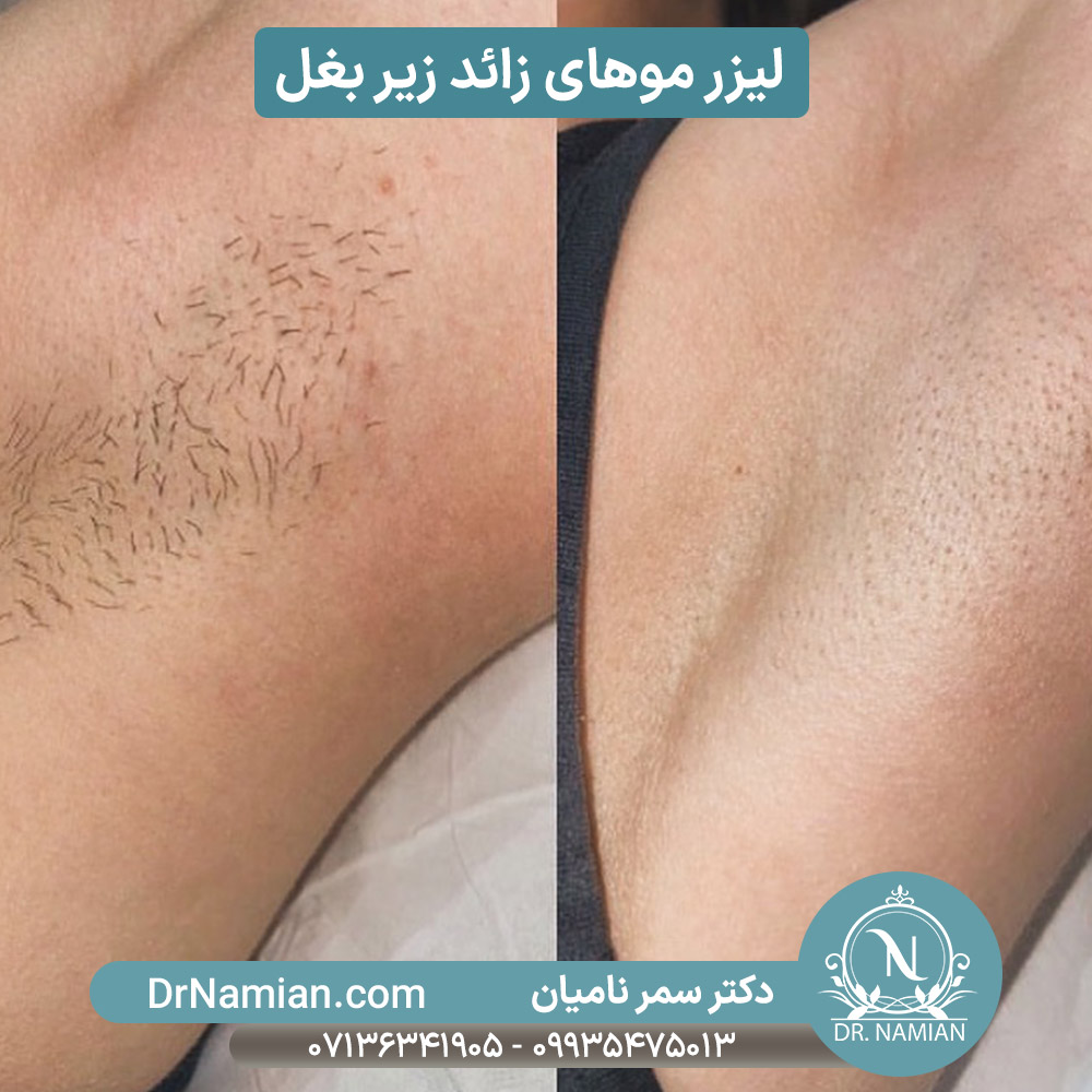 لیزر موهای زائد زیربغل شیراز