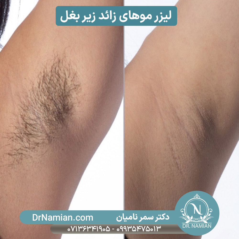 لیزر کردن موهای زائد زیر بغل