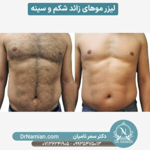 لیزر موهای زائد شکم و سینه در شیراز