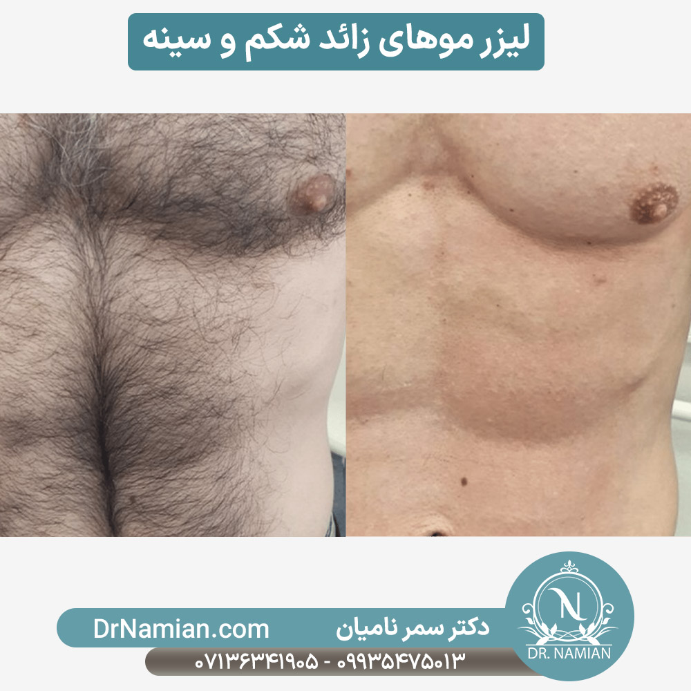 لیزر موهای زائد شکم و سینه آقایان در شیراز لیزر موهای زائد شکم و سینه آقایان در شیراز