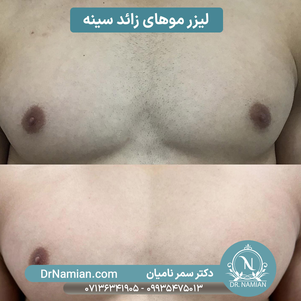 لیزر موهای زائد سینه در شیراز لیزر موهای زائد سینه در شیراز