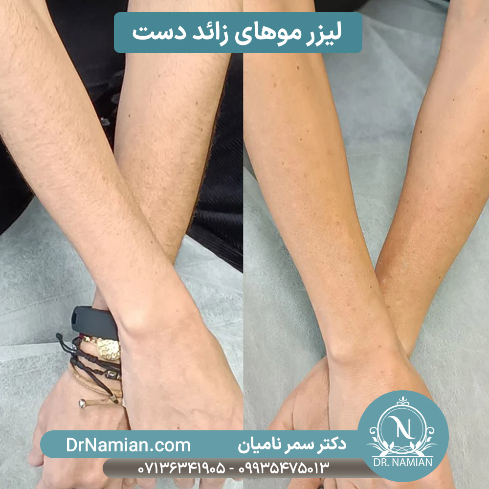 لیزر موهای زائد دست خانم ها در شیراز لیزر موهای زائد دست خانم ها در شیراز