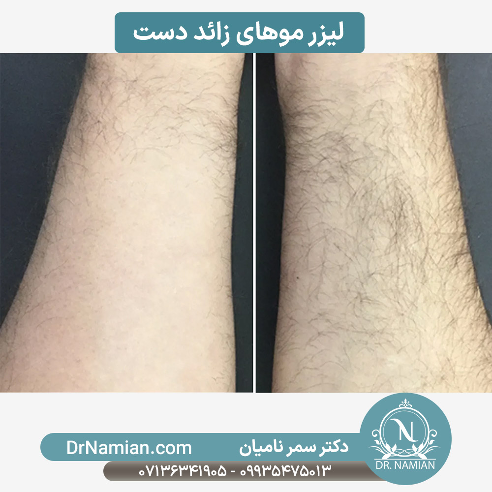لیزر موهای زائد دست آقایان در شیراز لیزر موهای زائد دست آقایان در شیراز