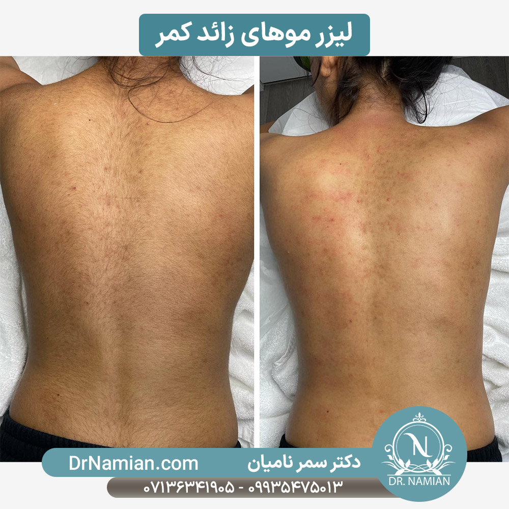 لیزر موهای زائد کمر خانم ها در شیراز لیزر موهای زائد کمر خانم ها در شیراز