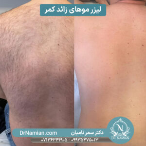 لیزر موهای زائد کمر در شیراز